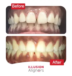 Illusion Aligners